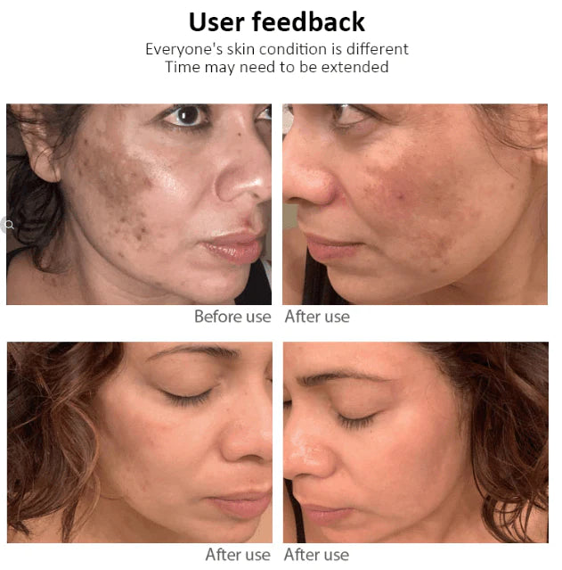 Dr.Hancy Whitening Freckle Cream Remove Acne Spots Melanin Dark Spots Face Moisturizing Face Skin Care